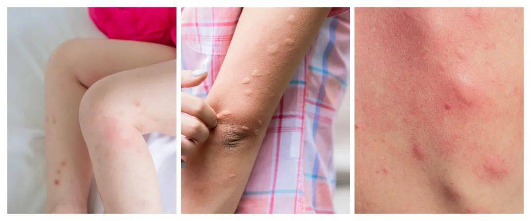 快停手挠破蚊子包可不止留疤这么简单