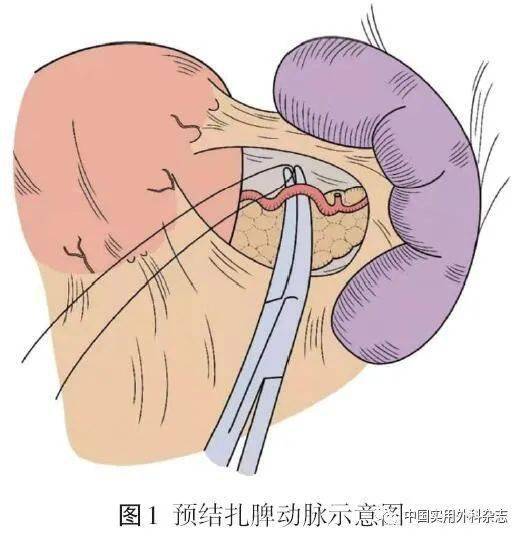 指南與共識開腹賁門周圍血管離斷術中國專家共識2022版