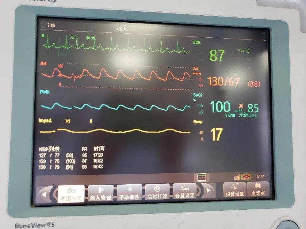 有创动脉血压的这三种情况,很多icu护士都遇见过!_监测_患者_导管