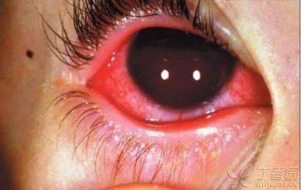 不同结膜病图文学习(高清多图)_分泌物_球菌_细胞