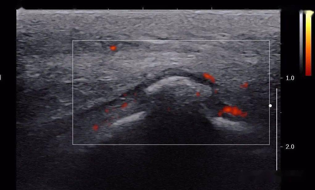 骨化性肌炎超声图片图片