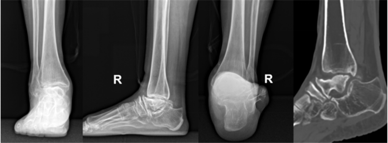 西安市红会医院完成一例高难度踝关节假体置换术_患者_梁晓军_关节炎