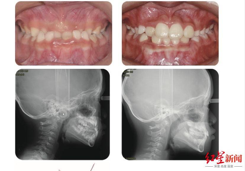 错牙合畸形影响近2