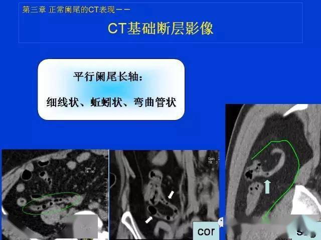 全面詳解正常闌尾和闌尾炎的ct表現