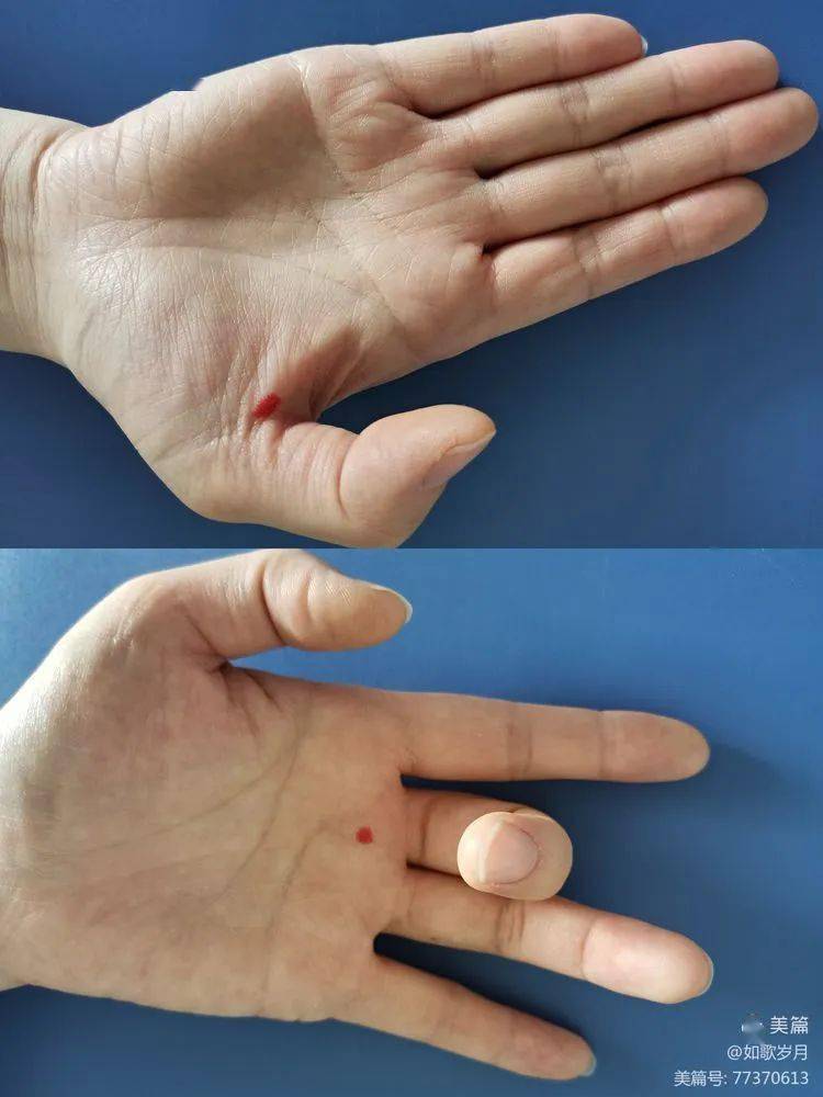 如出现上述症状,有可能是患了弹响指(扳机指),建议及时就诊,进行正规