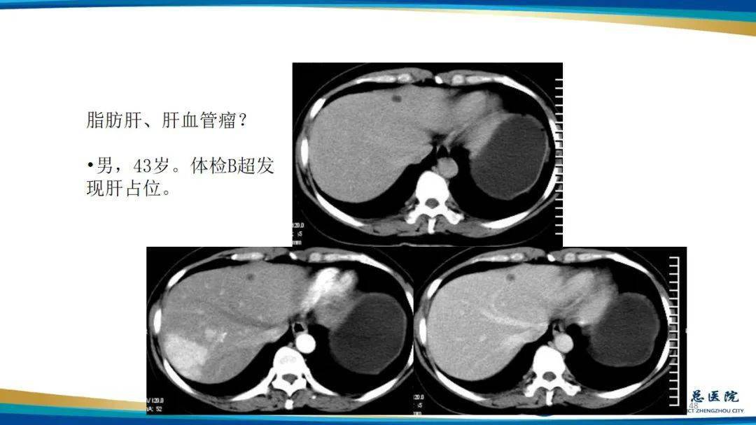 男性肝血管瘤图片