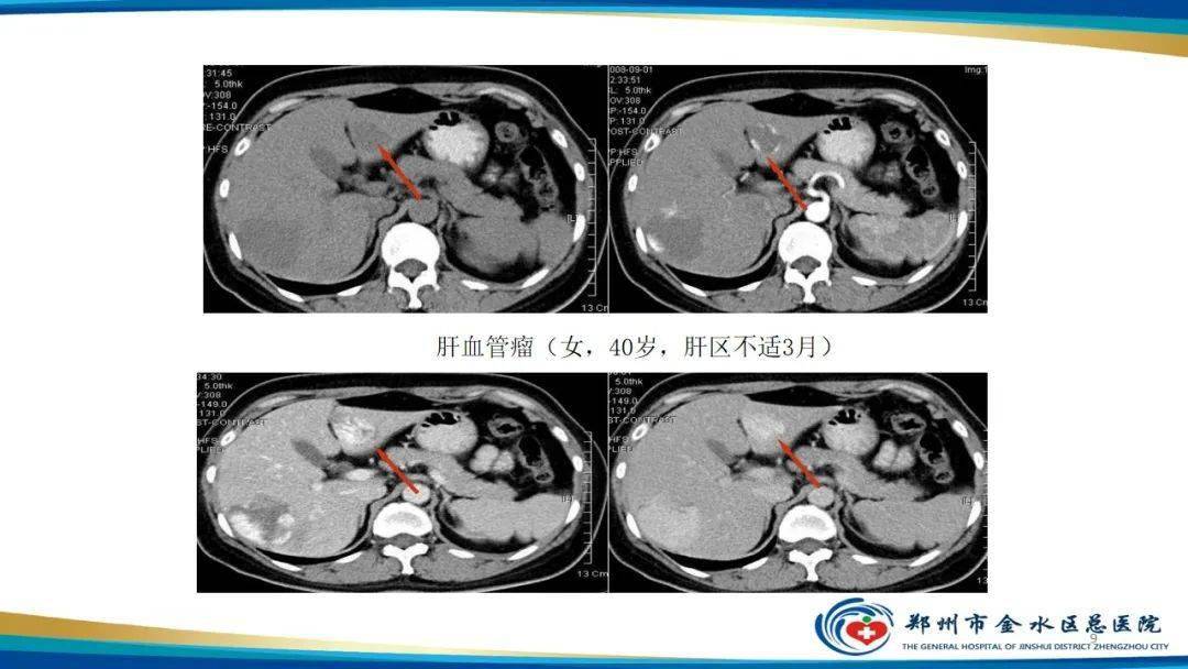 肝血管瘤影像學表現總結