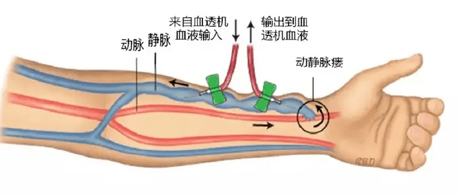 人工血管,肾衰患者血液透析的"生命延长线"