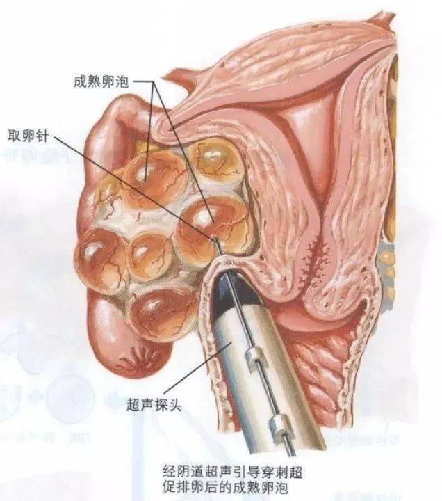 取卵手术几分钟图片