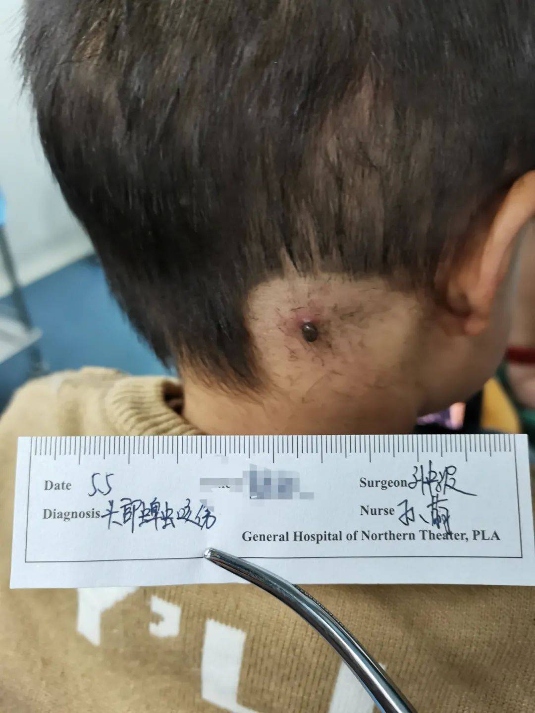 北部战区总医院刘中波医生接受采访称:医院每年都要处置10例左右蜱虫