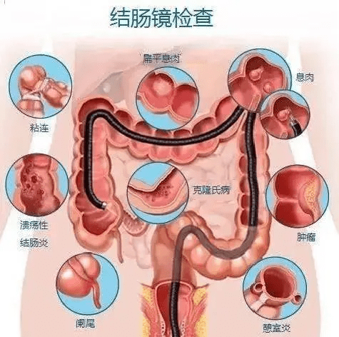 科普 肠镜检查那些事儿_肠道_横结肠_肿瘤