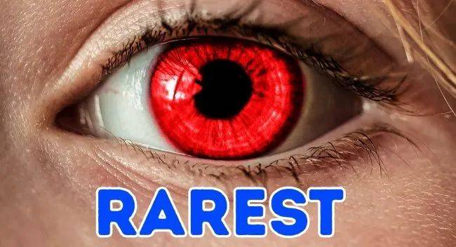 白化病患者常会有紫红色或红色的眼睛,是因为他们的虹膜缺乏色素的