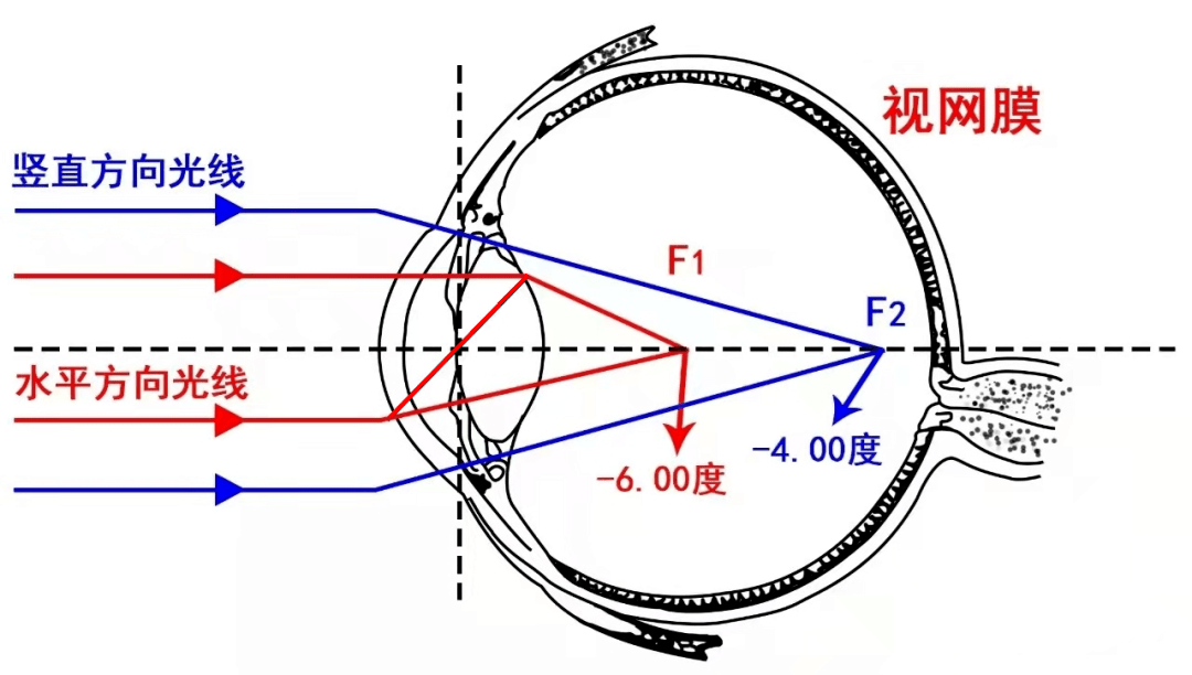 在各个方向的曲率半径是大致相同的,就不存在散光1角膜曲率是检测散光