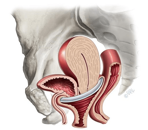 图1 用于治疗子宫脱垂,阴道壁膨出的子宫托子宫托对于任何一个年龄的