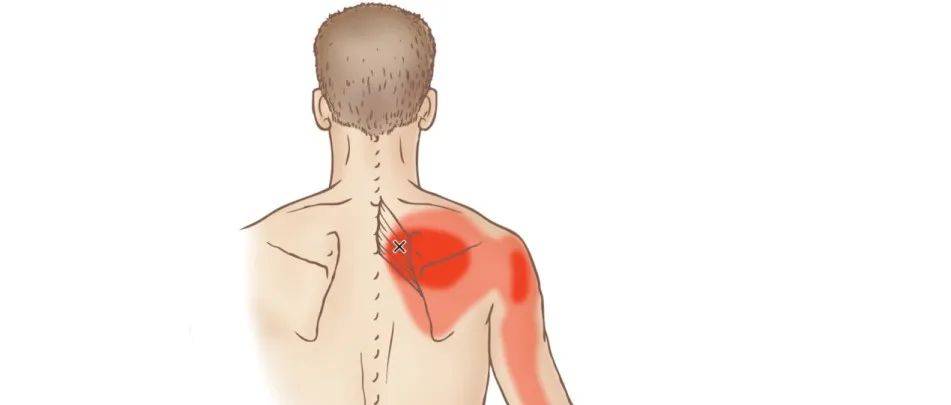【总结】胸背部疼痛的9种原因_治疗_针刺_原则