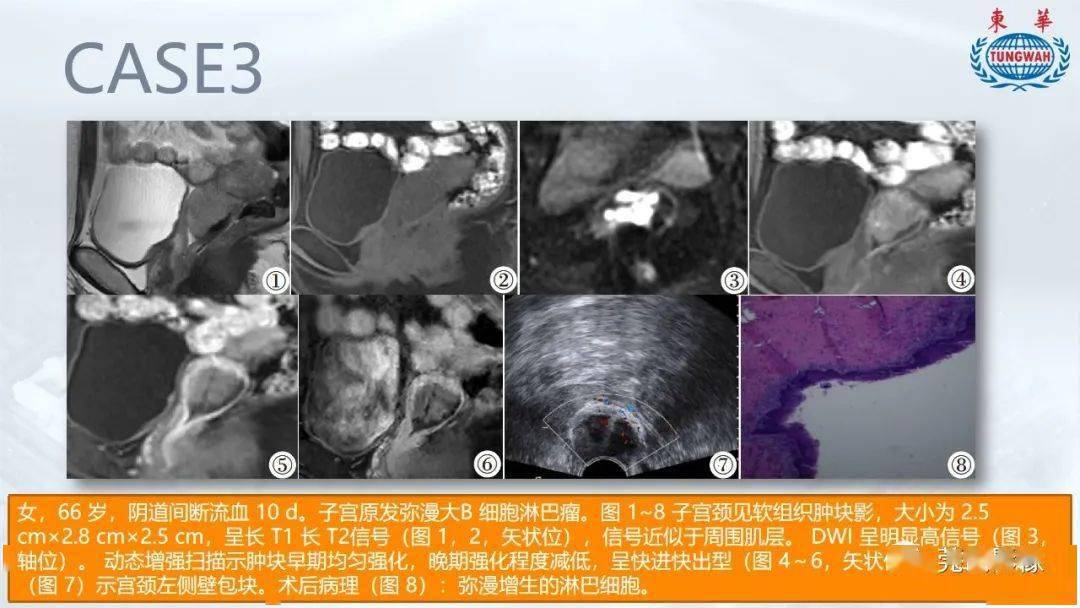 子宮原發性淋巴瘤的mr表現及鑑別