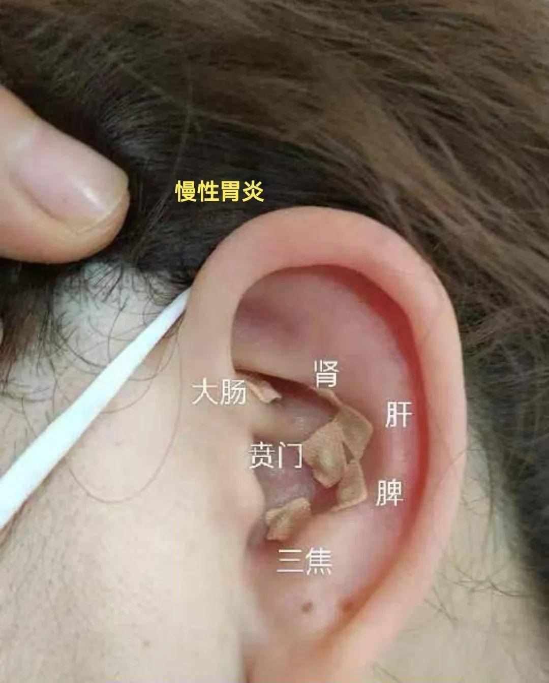 耳穴压豆治疗优势病