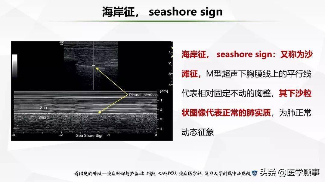 重症肺部超声基础