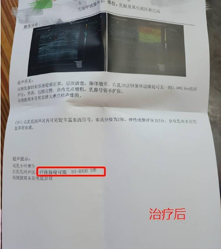 甲状腺结节4c 来自搜狐网