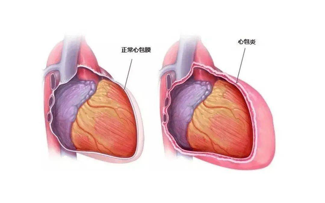 急性心包填塞是指心包腔内液体(炎症或血液等)急剧聚集或异常增多