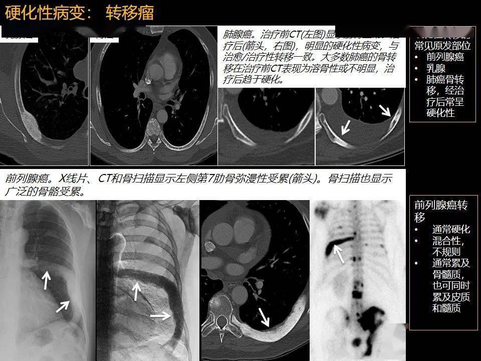 rsna精选内容肋骨肿瘤肿瘤样病变及获得性非创伤性病变的影像诊断基本