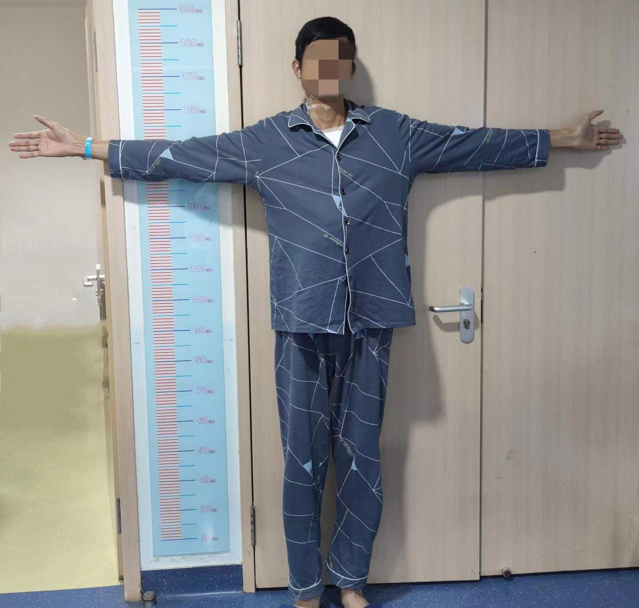 87米体重50公斤,如此好身材背后竟是患了这种罕见病_李方_心血管_马凡