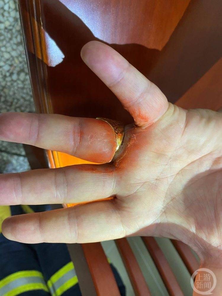 戒指卡手半月手指烂了才求助