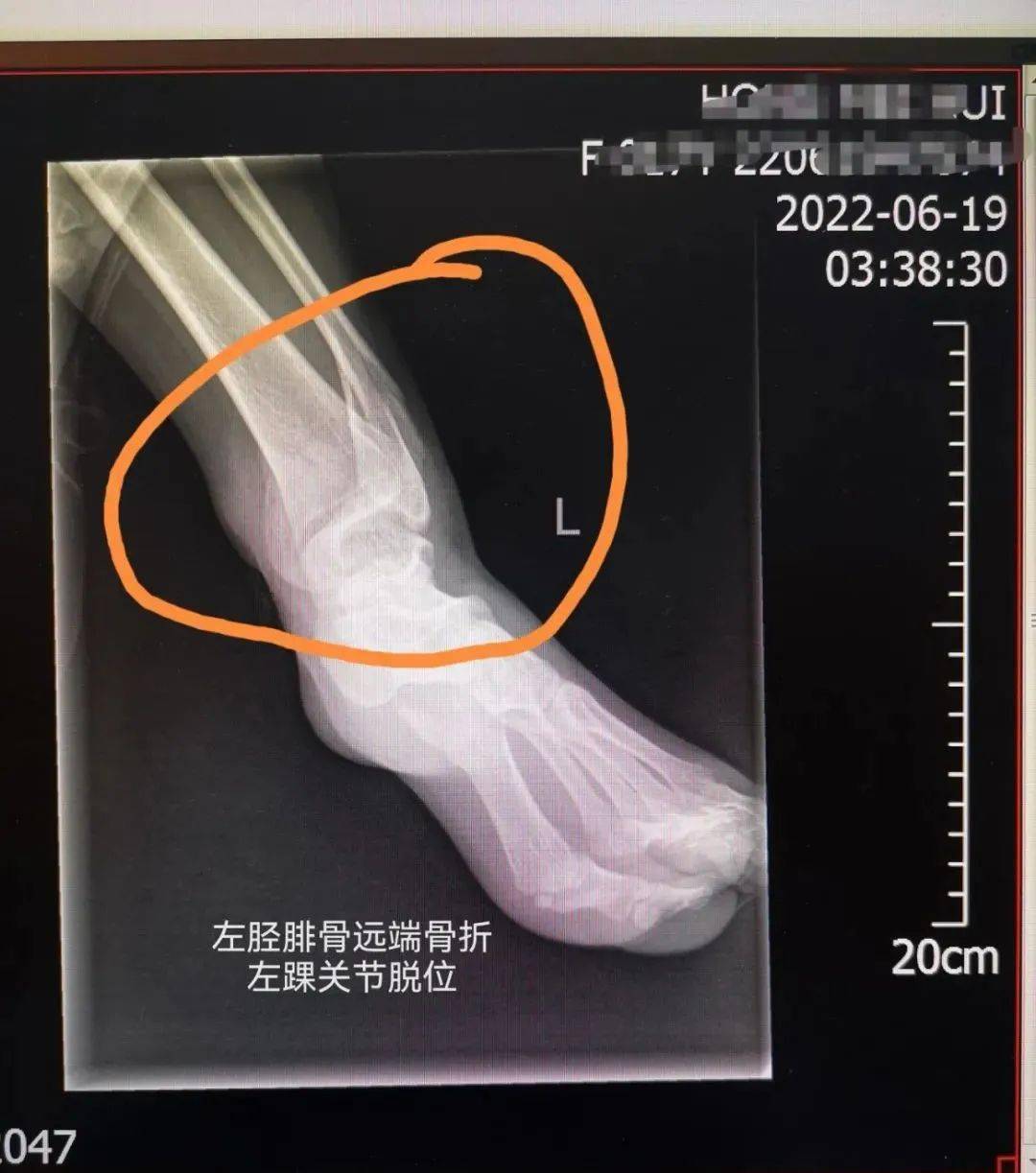 午夜骑飞车不可取 少女摔骨折真可惜 青少年 来时路 出行者