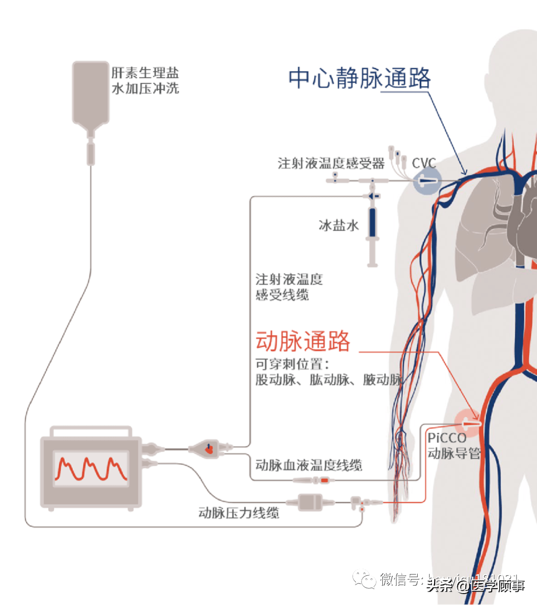 PiCCO技术工作原理及参数解读_搜狐网