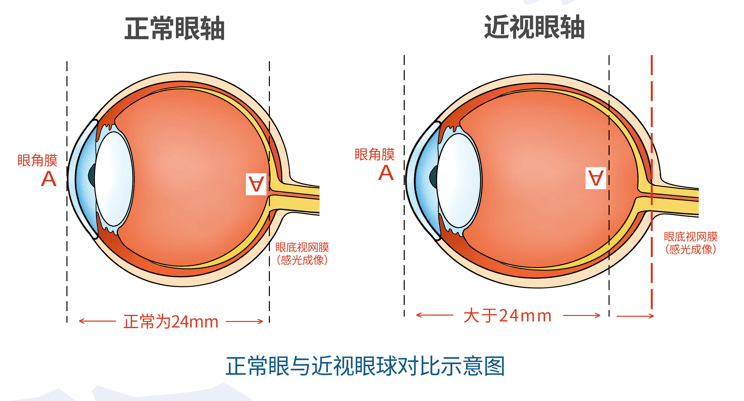 正常眼轴长度约为24mm,近视人群眼轴通常都
