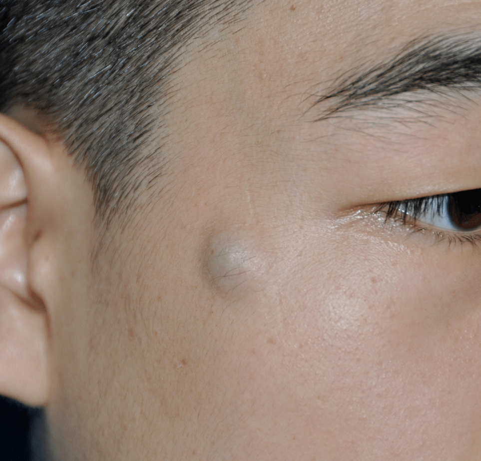 体表肿瘤科普这些常见的体表肿物能不能手术切除