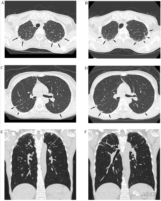 日常实践中ct上的胸膜肺实质弹力纤维增生症ppfe样表现患病率和系列