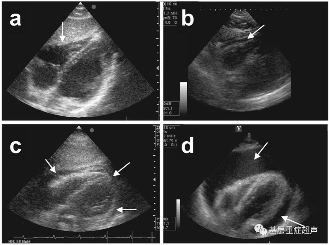 剑突下切面长轴,箭头指示生理量心包积液(a),前脂肪垫(b),少量心包
