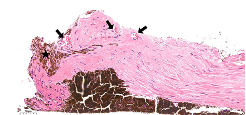病理切片显示(苏木精-伊红染色20×)该瞳孔区膜是由血管成分(黑色箭头