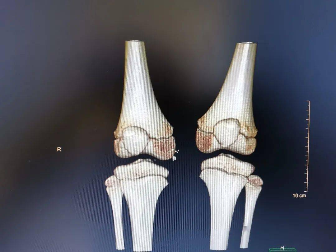 膝关节ct诊断报告模板图片