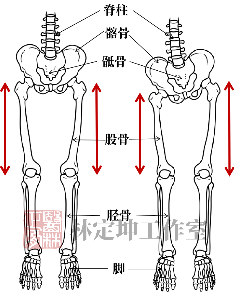 长短腿形成原因有很多种,大致可分为结构性(真性)长短腿和功能性