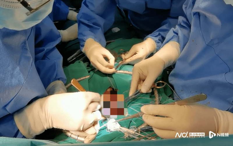 钳夹术修复瓣膜无痕摘胆囊邨里能做高难度四级手术了