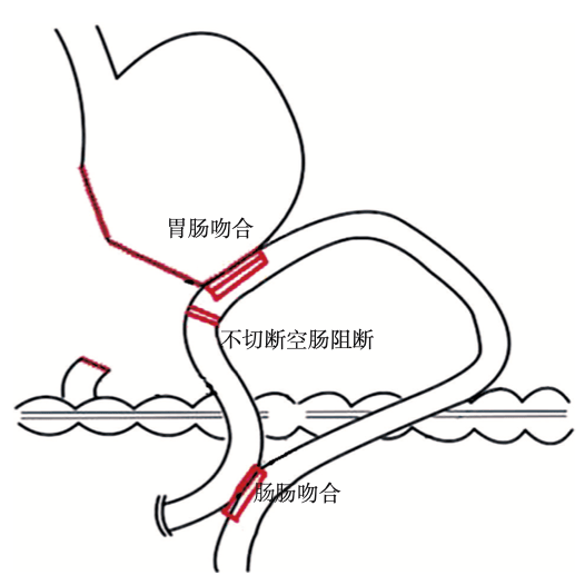 腹腔镜下肠吻合术图解图片