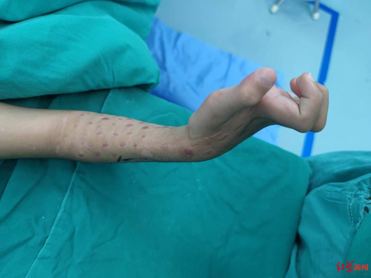 "肖成伟说,缺血性肌挛缩一旦发生,如果不及时治疗,就会导致儿童残疾.