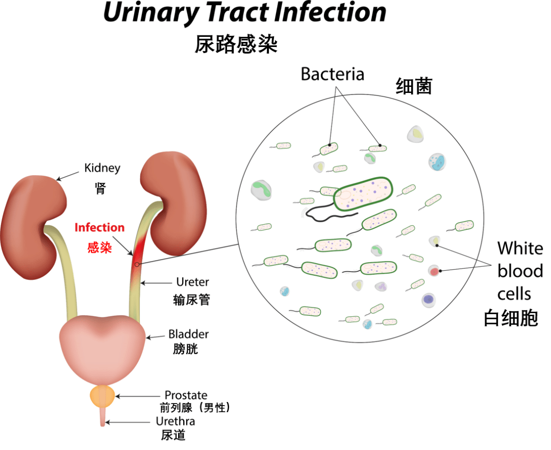 当细菌黏附于膀胱