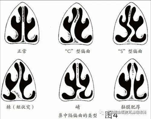 鼻中隔偏曲(nasal septumdeviation, nsd)指鼻中隔在形态上向鼻腔的