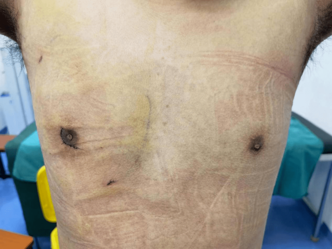 男性乳腺增生手术疤痕图片