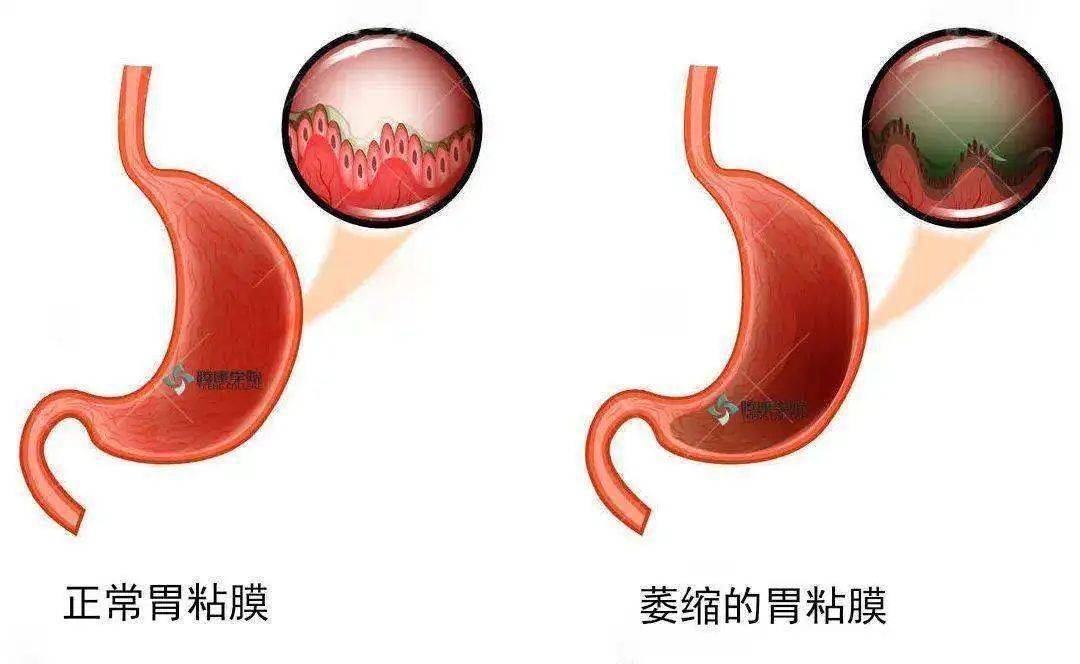 【小南話科普】萎縮,腸化都有了,離胃癌還遠嗎?_化生_萎縮性_粘膜