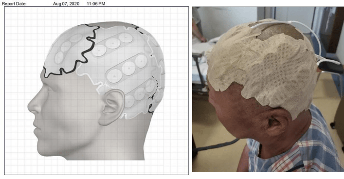 局部胶质母细胞瘤改变,放化疗联合肿瘤电场治疗,总生存期22个月,患者