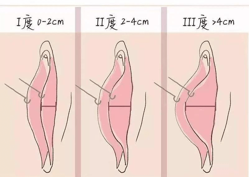 肥大的小阴唇会与内裤经常摩擦,造成外阴部产生疼痛感,严重影响到日常
