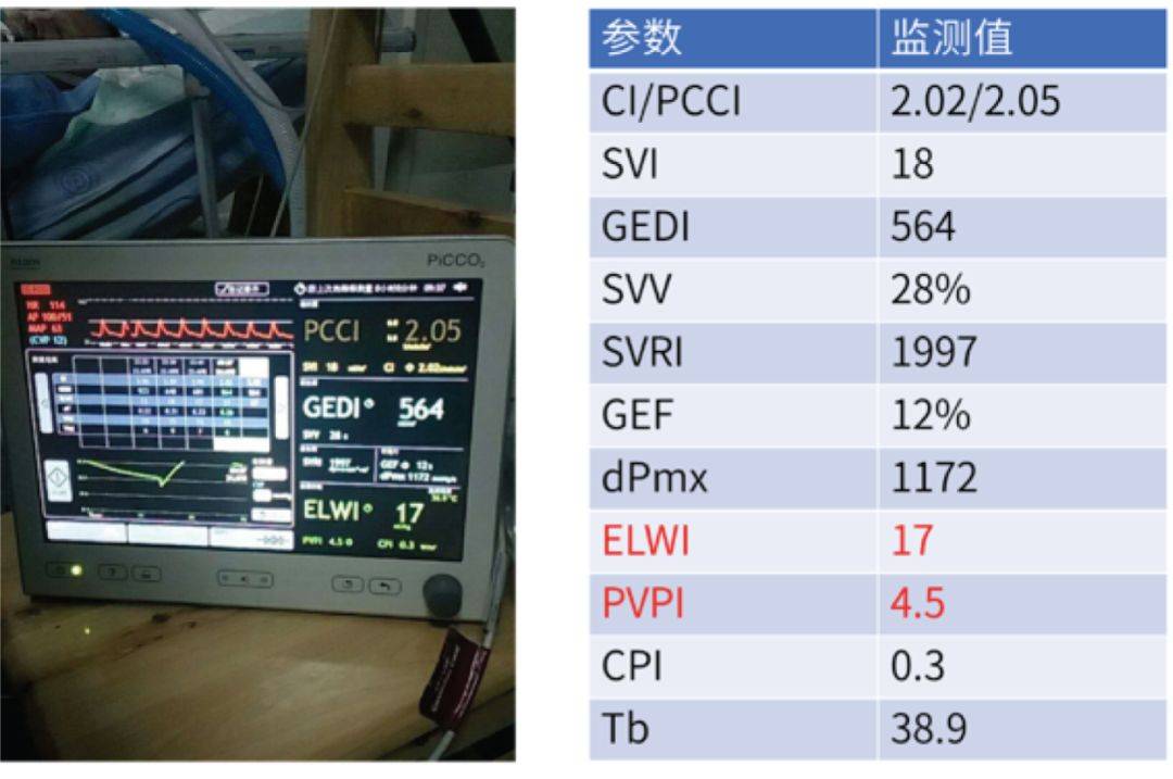 重症监测技术:picco监测血管外肺水指数(elwi)和肺血管通透性指数(pvp