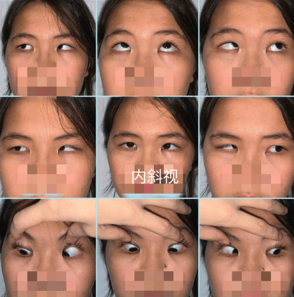 水平斜视分为外斜视和内斜视,其中间歇性外斜视是儿童最常见的斜视