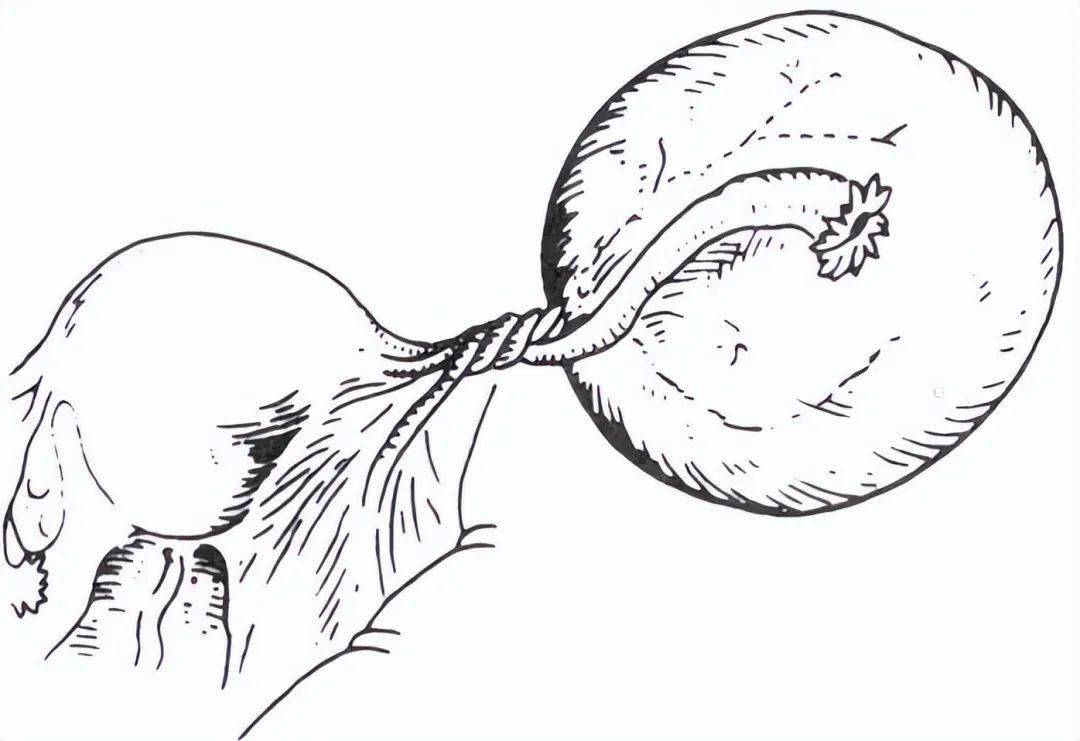盆腔内15*15*13cm的巨大囊性包块,以右侧卵巢固有韧带,右侧输卵管峡部