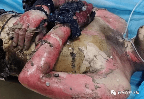 重度烧伤95%!安庆一地焊接油罐发生爆炸!_潜山_余四海_治疗