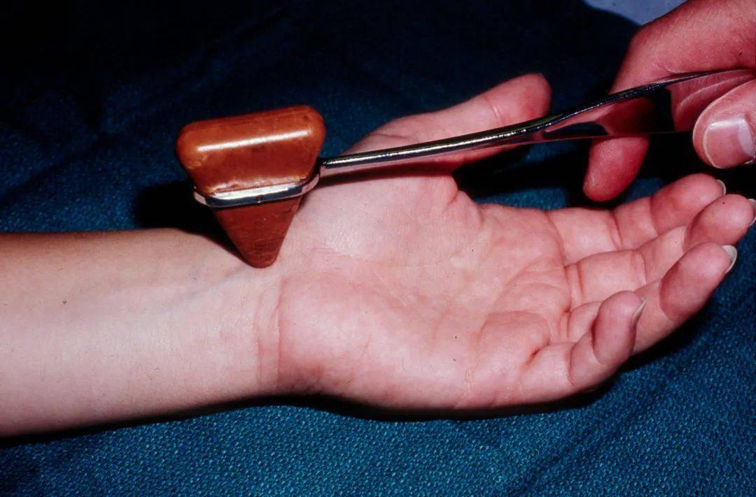 由于正中神经走行于旋前圆肌下方,因此旋前圆及综合征也会表现出tinel